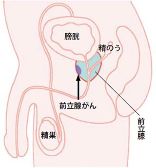 泌尿器のがん「前立腺がん」