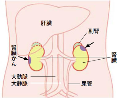 消化器のがん「腎臓がん」