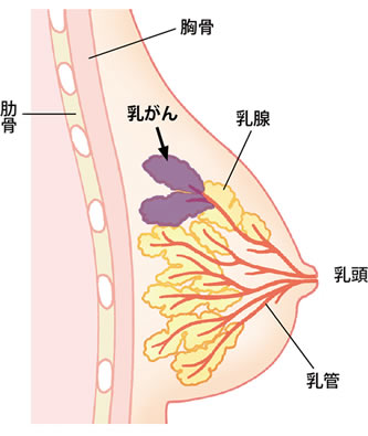 女性がかかるもっとも多いがん「乳がん」