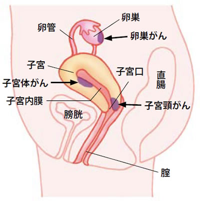 子宮がん