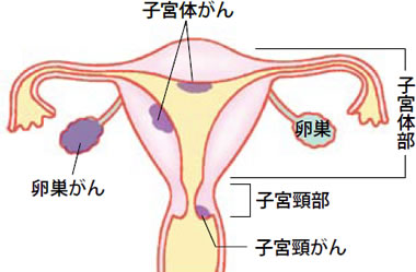 子宮頸がんと子宮体がん