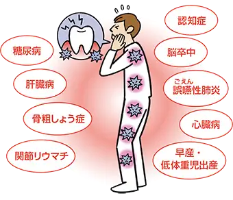 図解:歯周病が全身に及ぼす悪影響