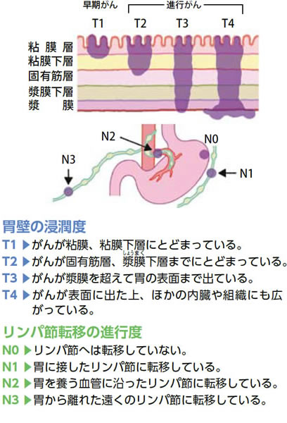 胃壁の浸潤度・リンパ節転移の進行度