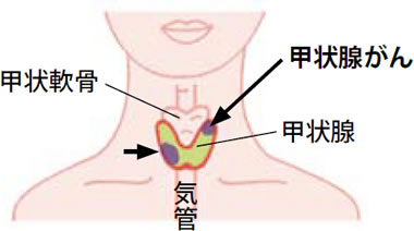 甲状腺がん